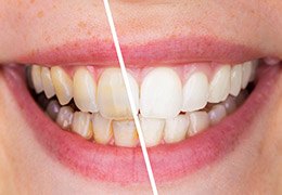 Teeth before and after whitening