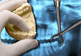Model and x-ray of tooth to be removed