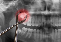 X-ray with red highlighted wisdom tooth