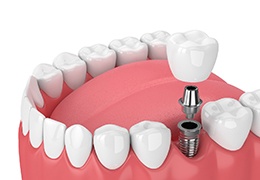 Diagram of a single tooth dental implant in Prestonsburg