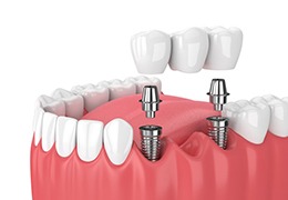 Diagram showing implant bridge replacing multiple missing teeth in Prestonsburg