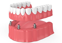 Diagram showing an implant denture in Prestonsburg