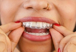 Close-up of woman placing SureSmile aligner on her teeth