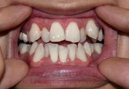 Close-up view of patient’s crowded, overlapping teeth