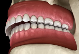 Digital illustration of a significant overbite
