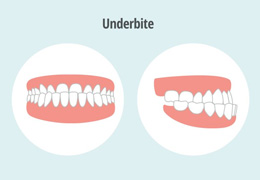 Front and side view illustrations of underbite