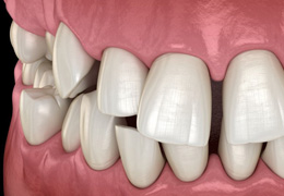 Close-up illustration of a crossbite