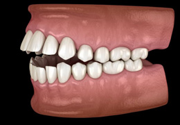 Side-view illustration of an open bite