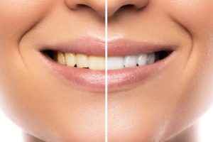 Yellow teeth in Prestonsburg before and after treatment