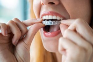 Woman placing SureSmile aligner on her top teeth