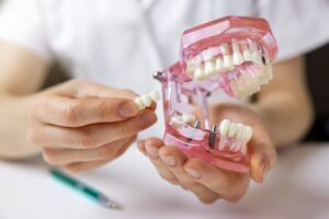 Dentist using model to share information about dental implants 