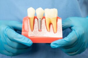 Gloved hands holding model of a dental implant between two natural teeth 